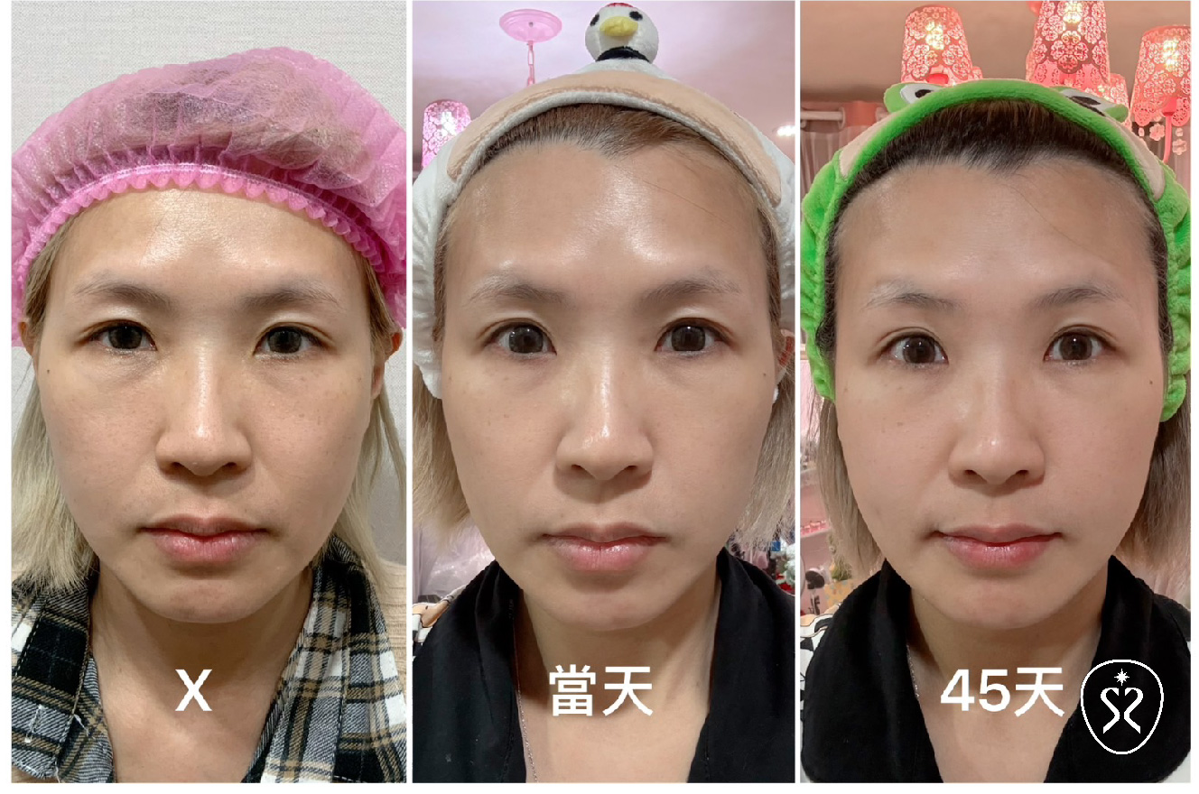 玩美電波隨著膠原蛋白新生重組期間的2至6個月內感覺效果較為顯著